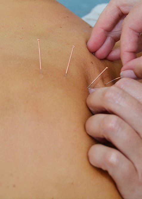 Acupuncture and Dry Needling